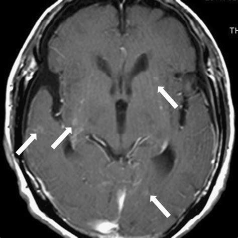 T1 Weighted Gadolinium Contrast Enhanced Magnetic Resonance Imaging