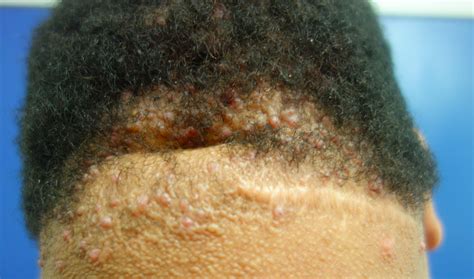 Acne Keloidalis Nuchae — Osei Tutu Dermatology