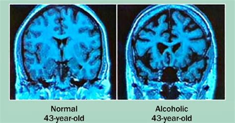 Its No Secret That Alcohol Affects The Brain It Can Cause Blurry