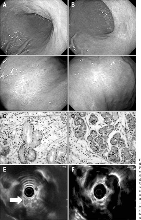 Figure 2 From Regression Of Advanced Gastric Malt Lymphoma After The