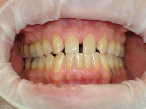 Verminderter speichelfluss hat nicht nur für die mundgesundheit folgen, sondern. Xerostomie | Apdental