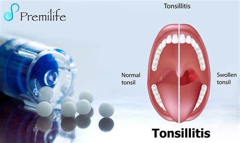Tonsillitis Premilife Homeopathic Remedies