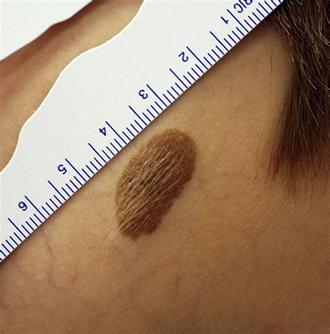 Congenital Hairy Nevus Pictures Telegraph