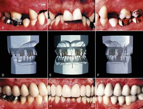 Interrelationship Of Orthodontics With Periodontics And Restorative