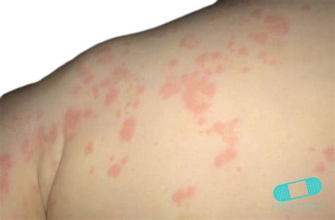 10 Common Rashes On Kids With Photos Symptoms And Treatment Images