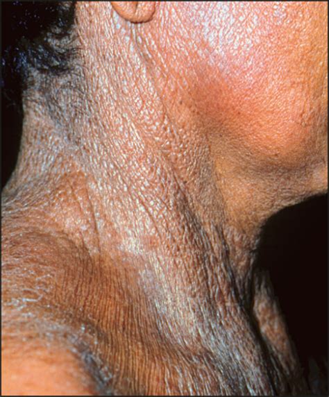 lax skin masses in a 47 year old woman—quiz case dermatology jama dermatology jama network