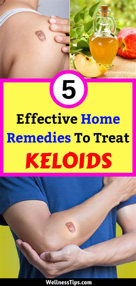 5 Effective Home Remedies To Treat Keloids Home Remedies Remedies