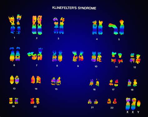 Klinefelters Syndrome Karyotype Bild Kaufen Science Photo