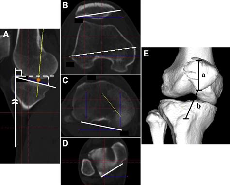 Inverted V Shaped High Tibial Osteotomy Decreases The Posterior Tibial