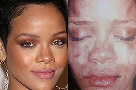 Rihannas Battered Face Leaked Picture Shows Injuries After Alleged