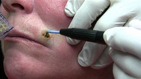 Dr Niamtu Removes A Very Large Mole For With Ellman