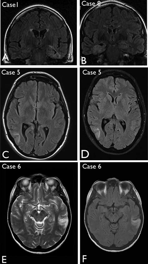 Neuroimaging Features Of Multinodular And Vacuolating Neuronal Tumour