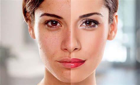Laser Skin Whitening Treatment Before And After Your Magazine Lite