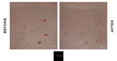 Using laser therapy, you can have your cherry angioma speedily removed. Cherry Angiomas Removal | Clinique Chloe