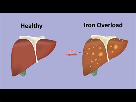 Haemochromatosis Iron Overload Types Symptoms Causes Diagnosis