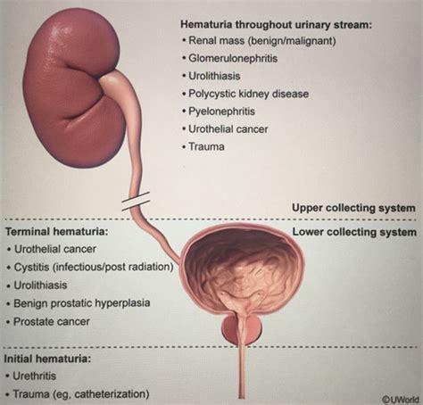 Hematuria And Uti Flashcards Quizlet