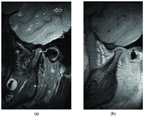 A Sagittal T2 Weighted Fat Suppressed Mr Image Of The Left