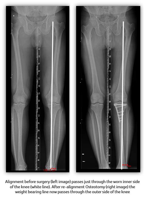 Keyhole Knee Surgery Knee Injury Treatment Tunbridge Wells
