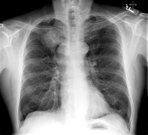 Chest X Ray Showing The Lungs Heart Ribs Stock Image