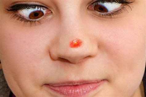 Pimple On Nose Causes How To Get Rid Of Big Cystic Pimple On Nose