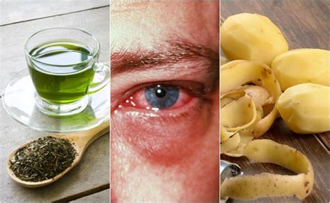 Curare la congiuntivite con rimedi naturali — Vivere più sani