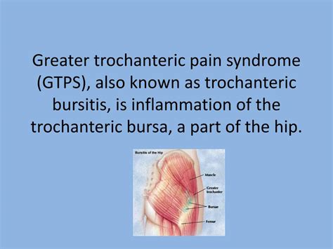 Hip Pain Trochanteric Bursitis Treatment