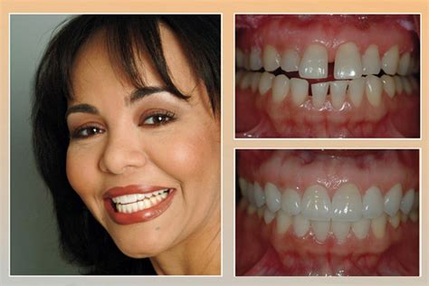 Ack Smiles Will Be Designing Smiles With Porcelain Veneers Said Dr
