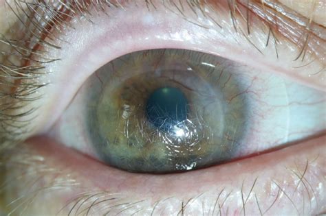Four Troubleshooting Pearls For Scleral Lens Success