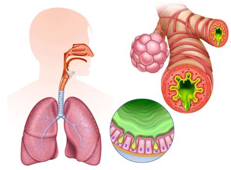 5 Remedios Efectivos Para La Bronquitis Aguda — Mejor Con Salud
