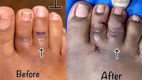 Minimally Invasive Toe Shortening Revision Surgery Before And After Youtube