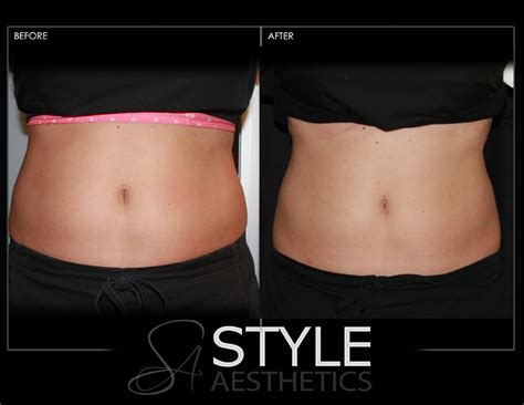 Coolsculpting Fat Removal Style Aesthetics By Rajanimd
