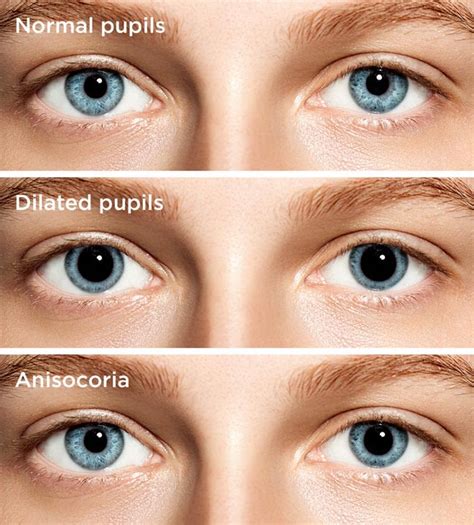 Pupilas Dilatadas Causas Preocupaciones Y Tratamiento Todo Sobre La