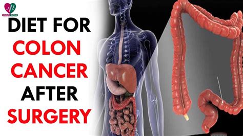 Diet For Colon Cancer After Surgery Health Sutra Youtube