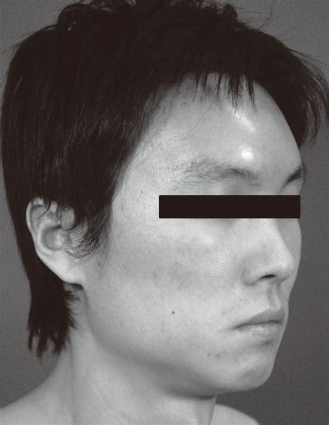 Patient Profile Showing The Soft Tissue Swelling Of The Left Forehead