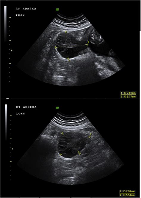 Ultrasound Scan Of The Right Ovary At 18 Weeks Gestation Upper Image