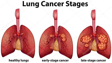 Beacon hospital is malaysia leading cancer specialist hospital using advanced cancer examination & treatment like halcyon radiotherapy, immunotherapy and radionuclide therapy. Diagram showing lung cancer stages — Stock Vector ...