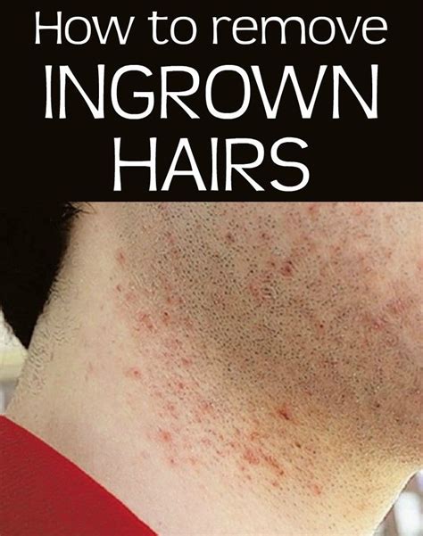Read Directions And Learn How To Remove Ingrown Hairs Ingrown Hair