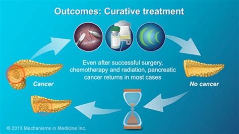 Pancreatic Cancer Treatment And Outcomes