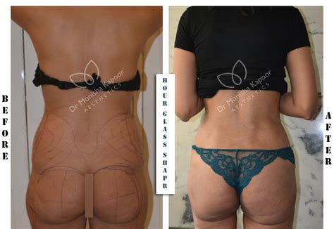 Brazilian Butt Lift Surgery Procedure Bbl At Best Price In Delhi At