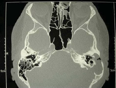 Case 2 Preoperative Computed Tomography Of The Left Mastoid Area