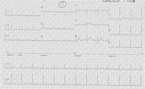 Figure 1 From St Elevation Myocardial Infarction Following Thrombolysis