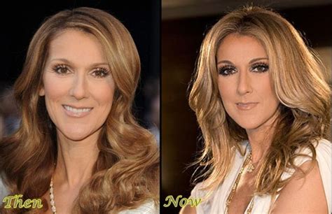 Celine Dion Plastic Surgery Before And After Photos Plastic Surgery Celine Dion Celebrity