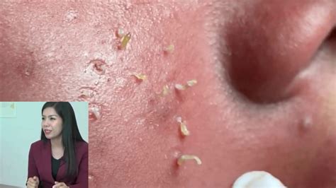 Cystic Acne Pimples And Blackheads Extraction On Face Acne Treatment