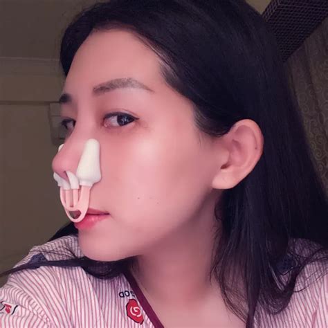 Japanese Nose Bridge Heightening Device Nose Clip Nose Clip High Warped