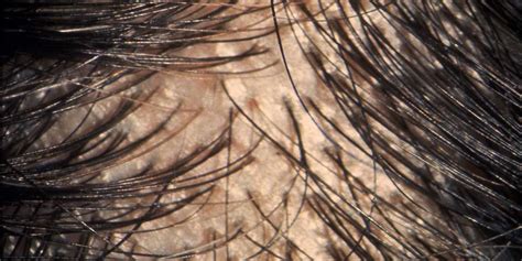 8 Ways To Tell If Your Hair Is Thinning Before Its Too Late Prevention