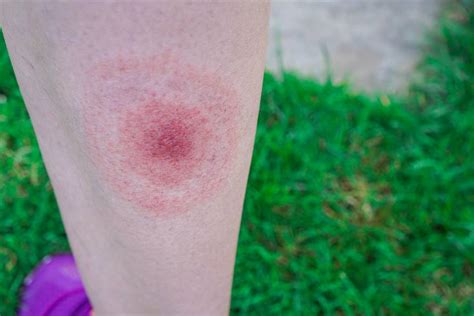 Enfermedad De Lyme Síntomas Y Cómo Prevenir La Picadura De Una Garrapata