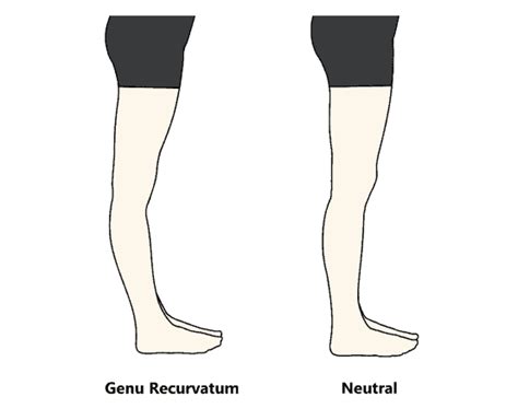 Genu Recurvatum Mississauga Chiropractor And Physiotherapy Clinic