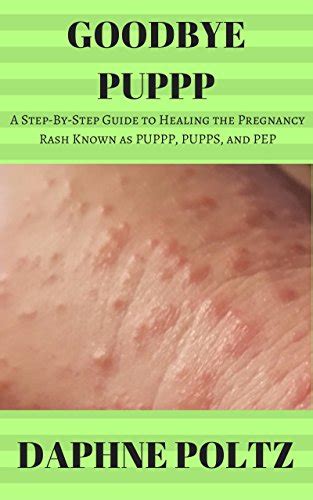 Goodbye Puppp A Step By Step Guide To Healing The Pregnancy Rash Known
