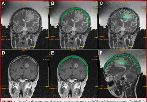 Figure 2 From Transcranial Magnetic Resonance Imaging Guided Focused
