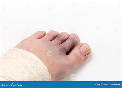 Bruising On The Toes After A Sprain Stock Photo Image Of Care Doctor